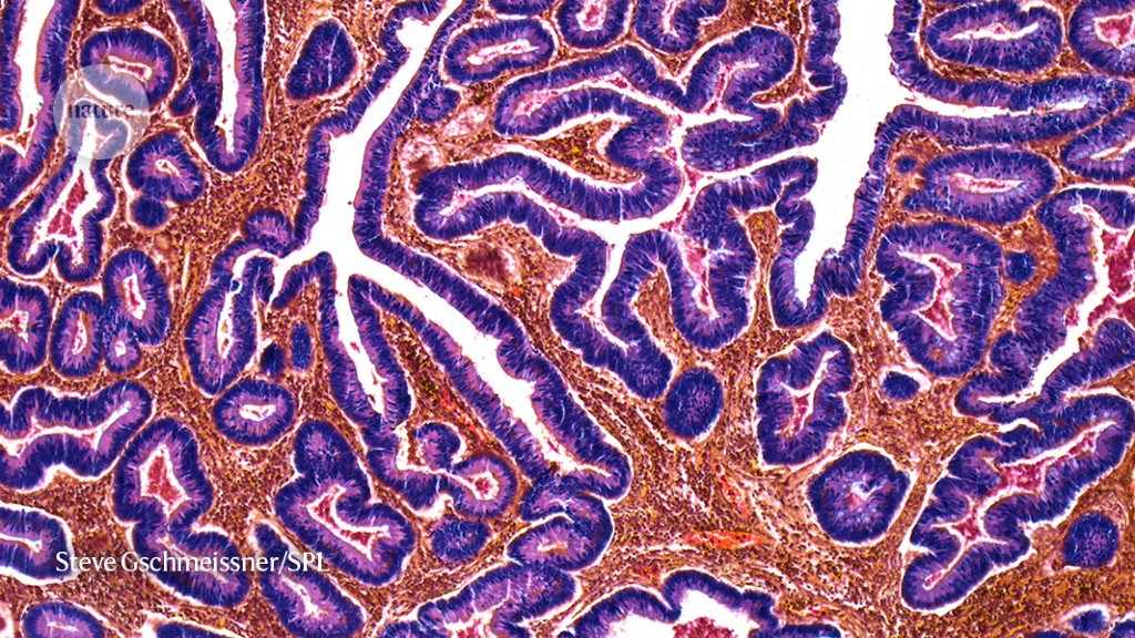 The Role of Y Chromosome in Cancer Growth and Outcomes.