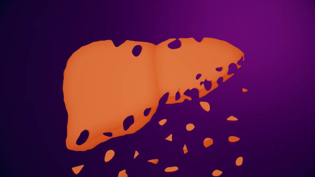 Featured image for ADA recommends screening for nonalcoholic fatty liver disease in all diabetes patients.