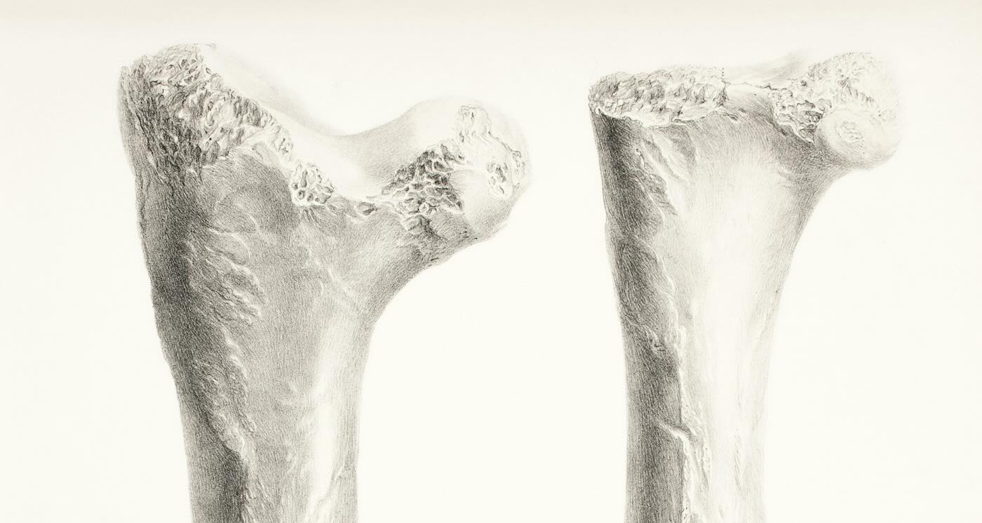 Featured image for Scientists Discover Switch to Prevent Osteoporosis and Strengthen Bones