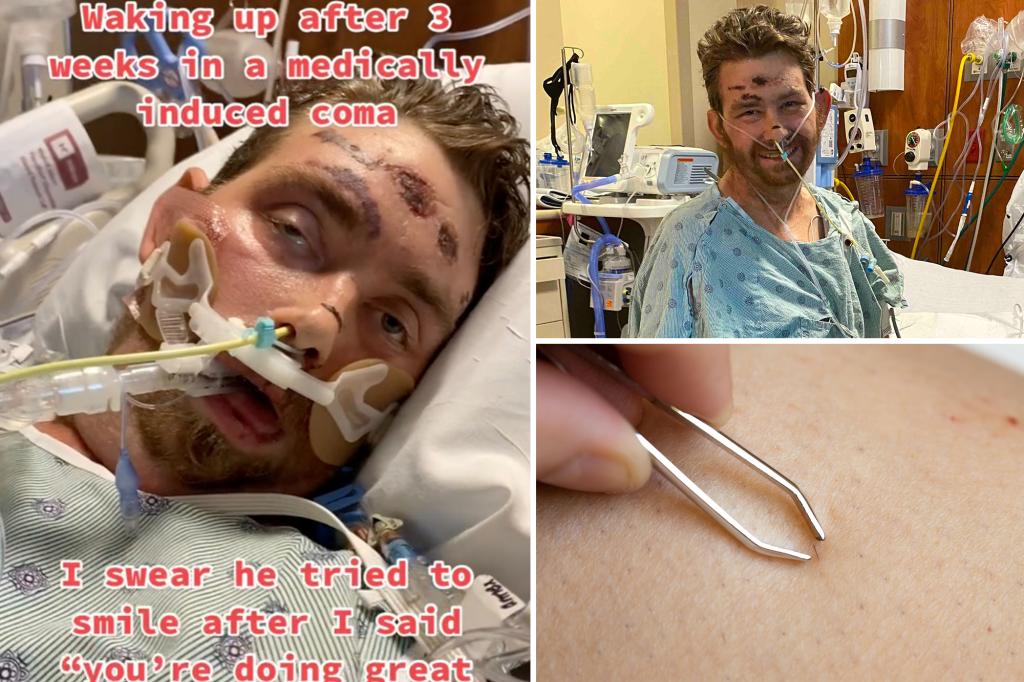 Featured image for "Ingrown Groin Hair Puts Man in Coma with 4% Survival Chance"