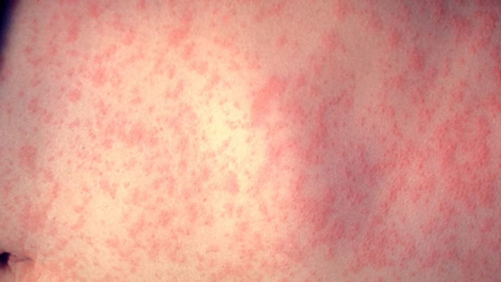 Featured image for Measles Exposure Warning Issued for LA County After Confirmed Case