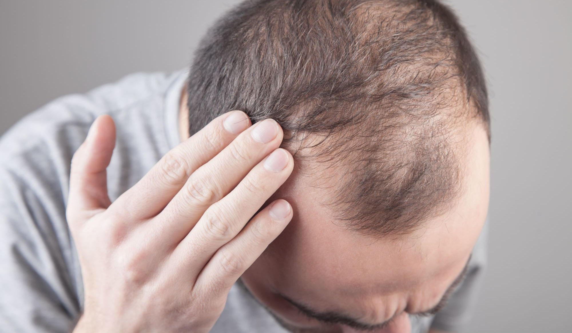 Featured image for Hair Loss Drug Finasteride Linked to Increased Suicide and Psychiatric Risks
