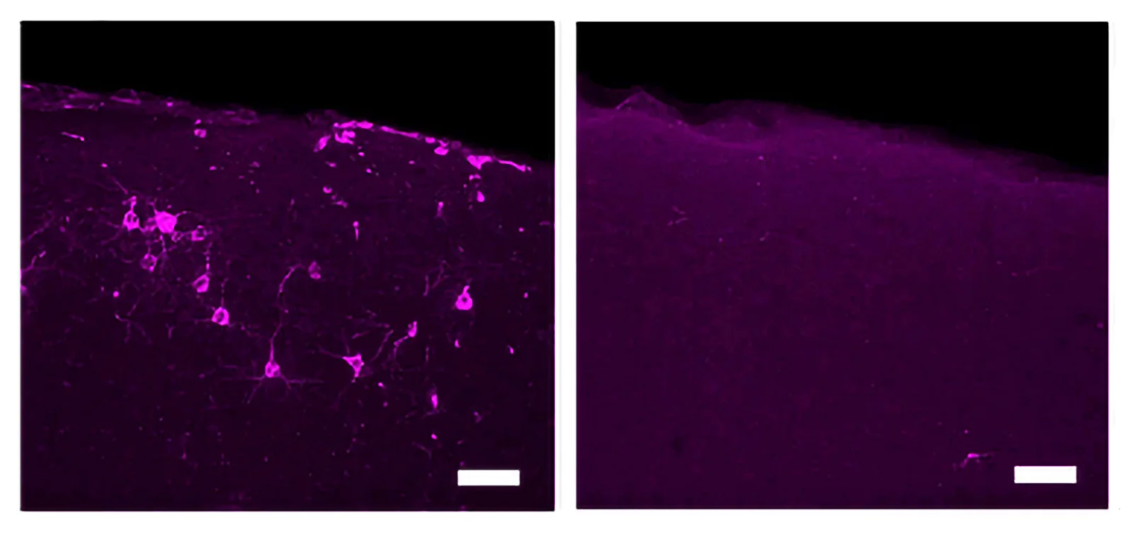 Tactile Stimulation at 40 Hz Reduces Alzheimer's Pathology and Symptoms.