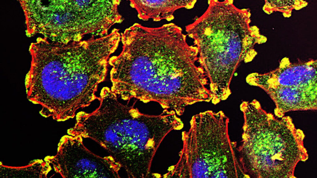 Featured image for "FDA Approves Revolutionary Cell Therapy for Metastatic Melanoma"