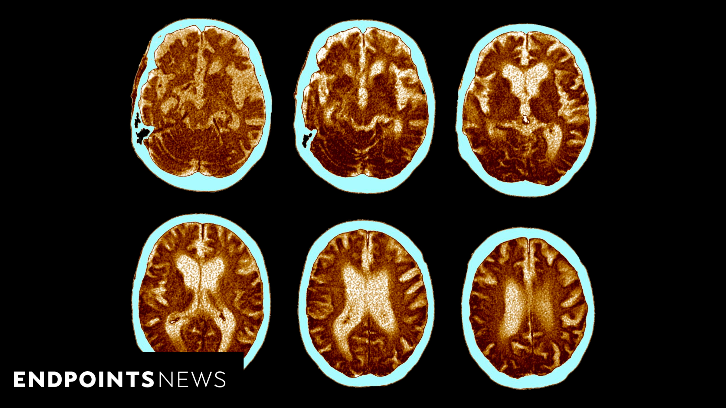 Featured image for "Promising Alzheimer's Drug Sparks Optimism and Uncertainty"