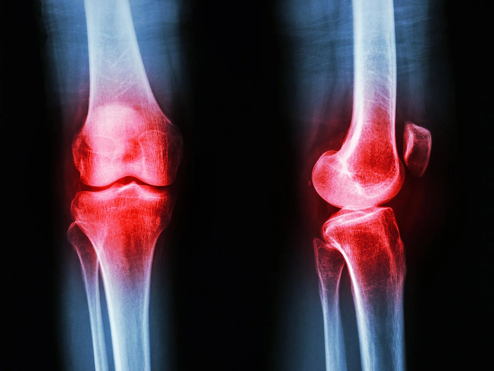 Move More, Heal More: Exercise as Osteoarthritis’s First-Line Treatment