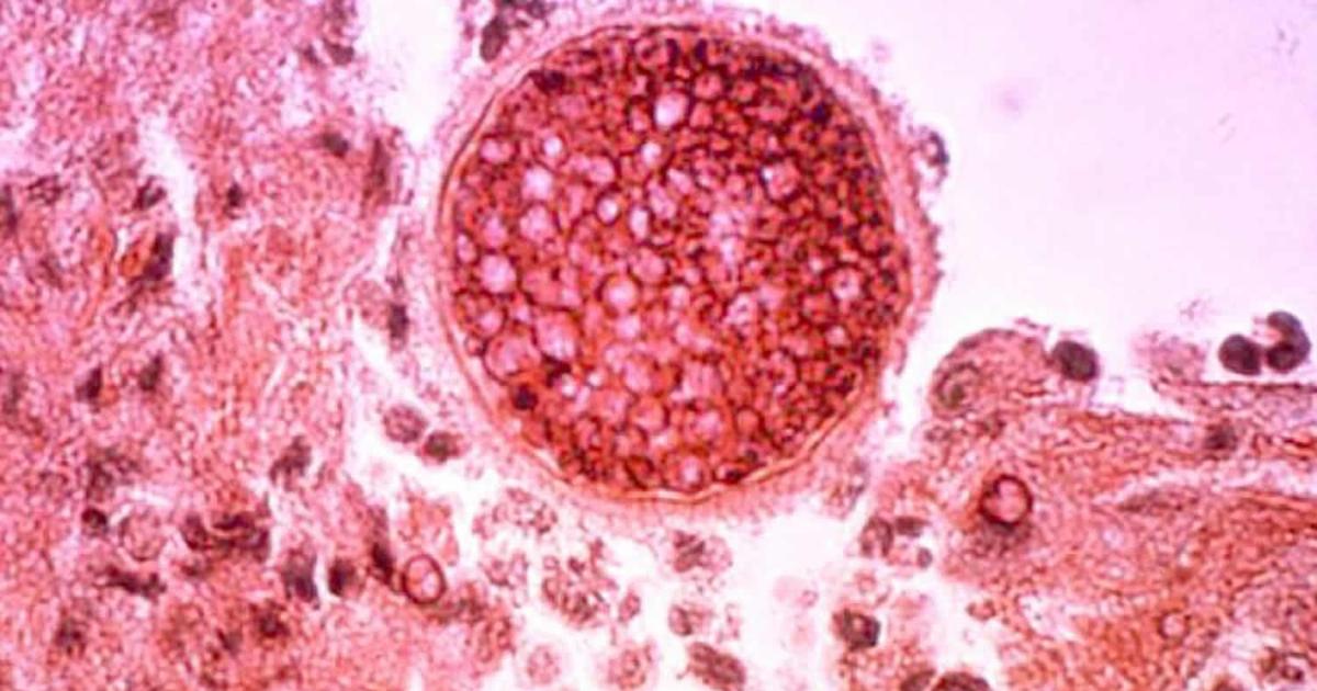 Featured image for "Climate Change Fuels Spread of Valley Fever in California Counties"