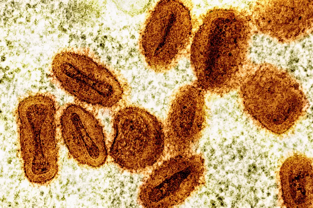 Featured image for First Severe Mpox Strain Detected in U.S. Traveler