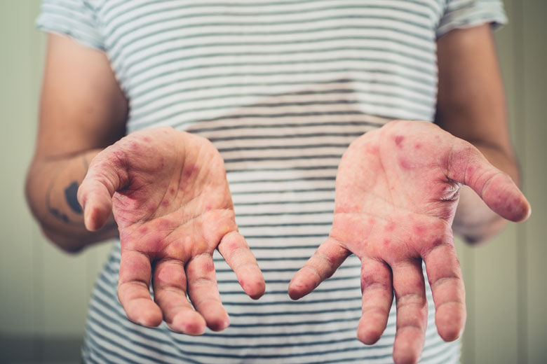 Virginia Sees Rise in Rash Cases; PhilHealth Highlights Hand, Foot, Mouth Disease Benefits