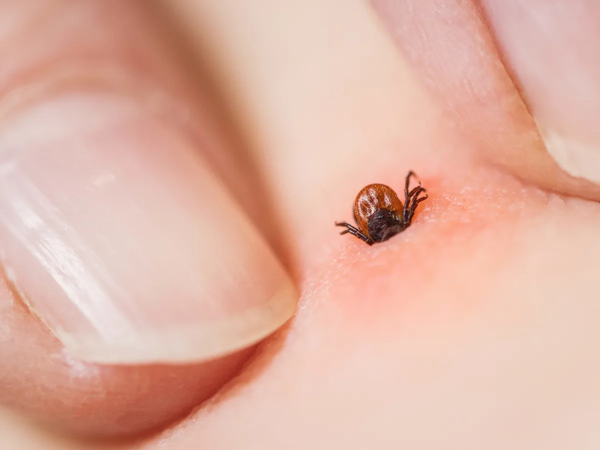 Featured image for The Dangers of Removing Ticks with Your Fingers, According to a Nurse