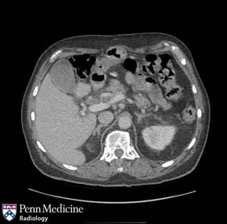 Featured image for "Unusual Case: 69-Year-Old Man Presents with Right Upper Quadrant Pain and Hematemesis"