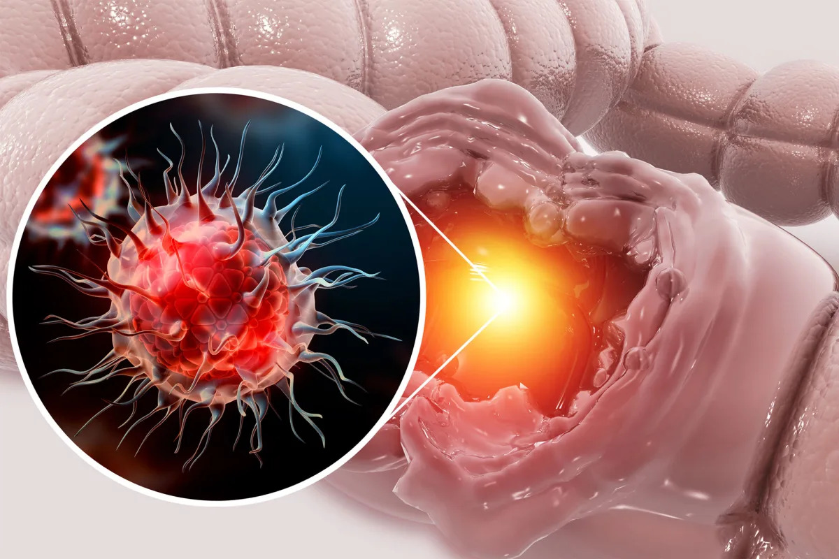 Protein Activation Shows Promise in Halting Colon Cancer Spread