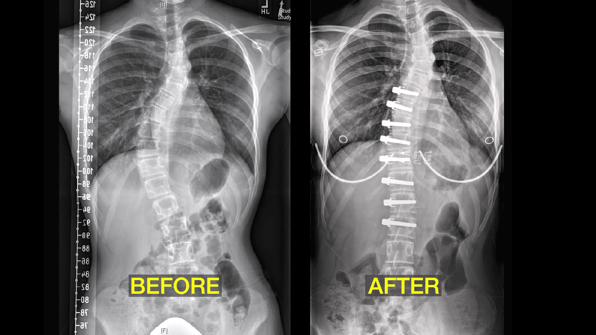 Featured image for Understanding and Treating Scoliosis at Different Stages of Life