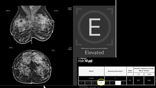 AI-aided mammograms cut risk of aggressive breast cancer in large Swedish trial