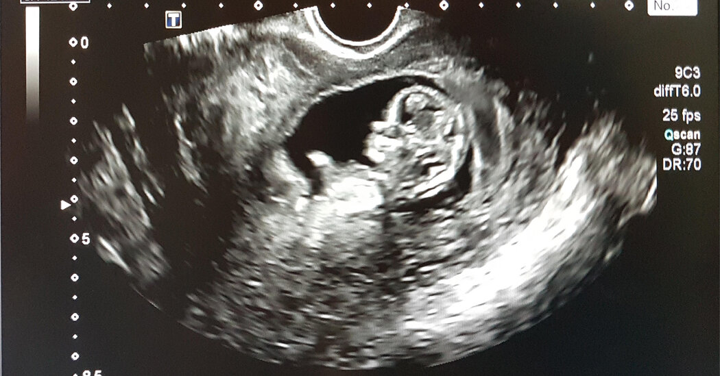 Featured image for Unveiling the Cause of Morning Sickness: Scientists Offer Hope for a Cure