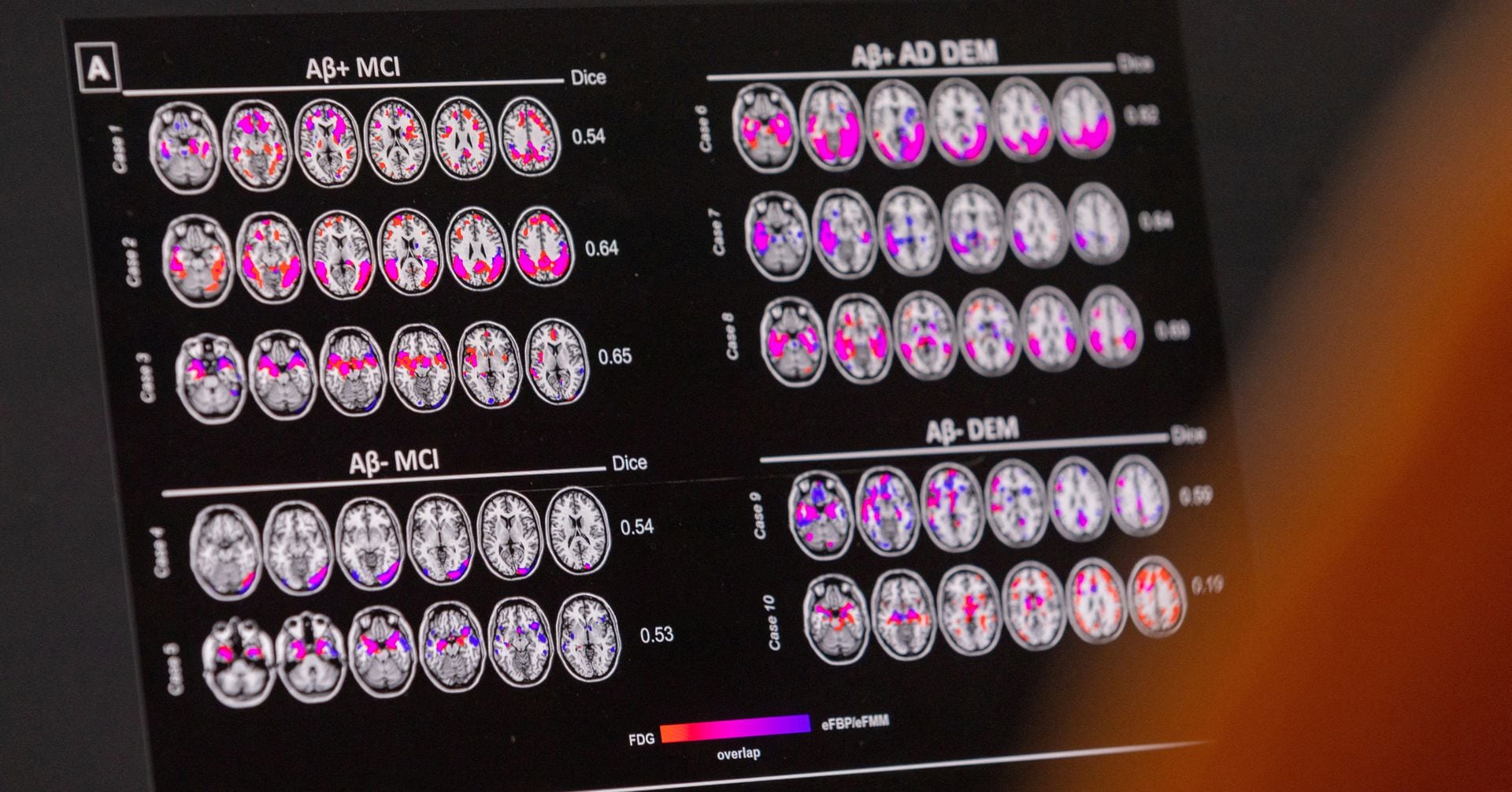 Blood Proteins Predict Dementia 15 Years in Advance