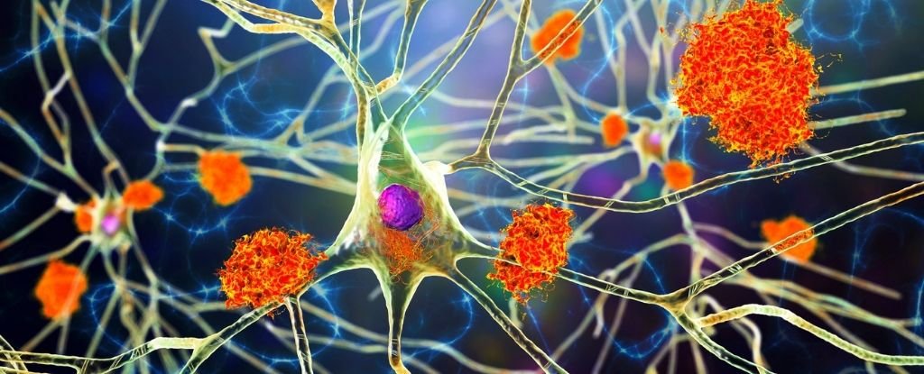Featured image for "Research on Half a Million Patients Strengthens Viral Connection to Alzheimer's"