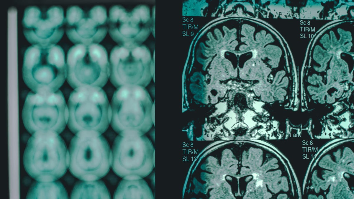 FDA Grants Full Approval to Promising Alzheimer's Drug, Boosting Biogen Stock