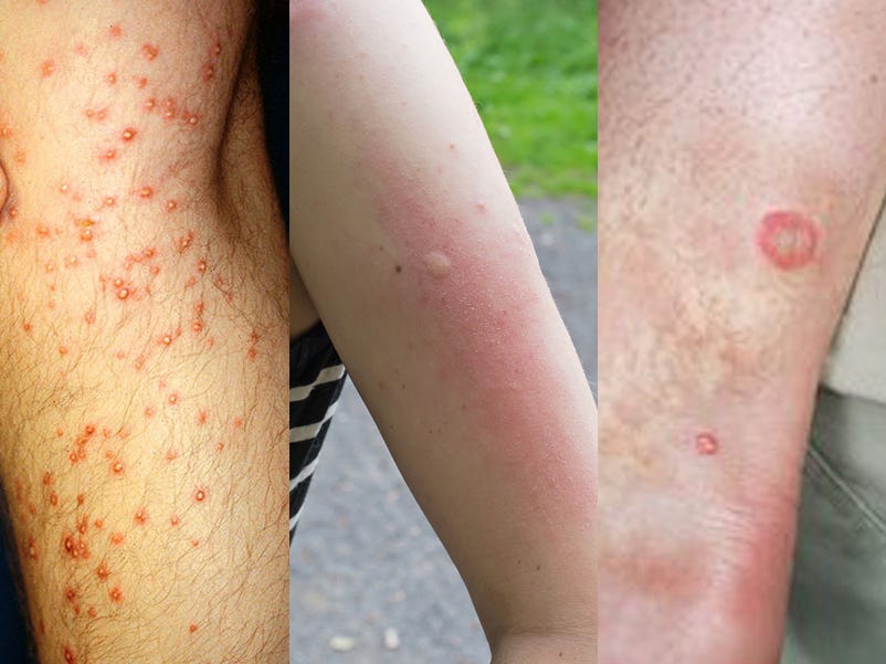 Featured image for Identifying 13 Common Bug Bites