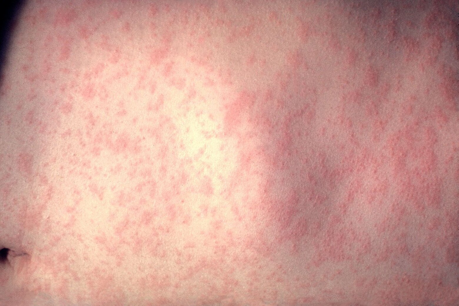 Featured image for Measles Exposure Alert Issued for Arlington and DC