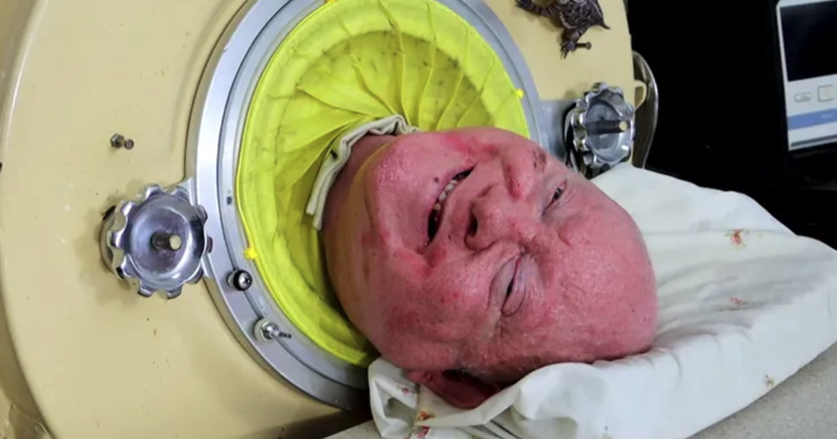 "Polio Survivor Paul Alexander, Who Lived in Iron Lung for 70 Years, Dies at 78"