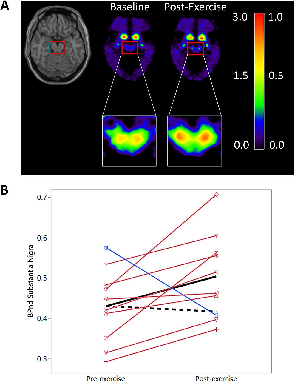 Featured image for "Study Shows High-Intensity Exercise Reverses Parkinson's Neurodegeneration"