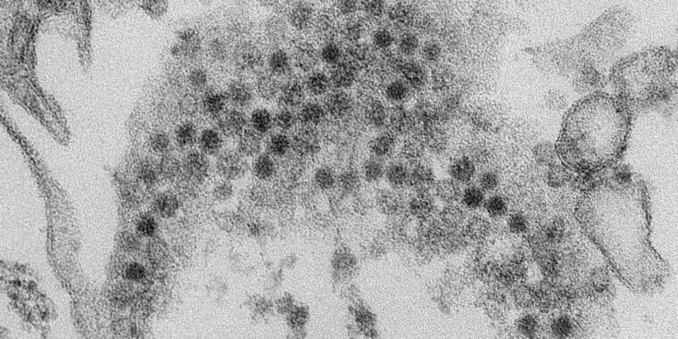 Featured image for "Decline in Biennial Acute Flaccid Myelitis Cases in the US"