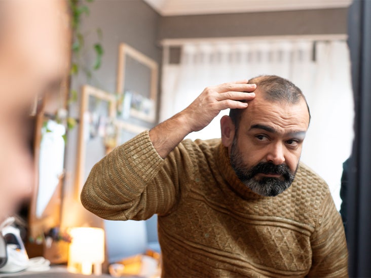 Featured image for Revolutionary Hair Loss Solution Discovered: Harnessing the Power of MicroRNA and Hairy Moles