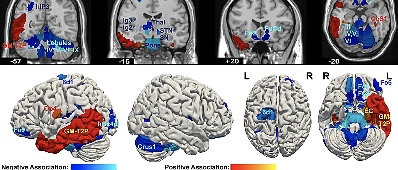 Featured image for Brain Networks Linked to Psychopathy Identified in New Study