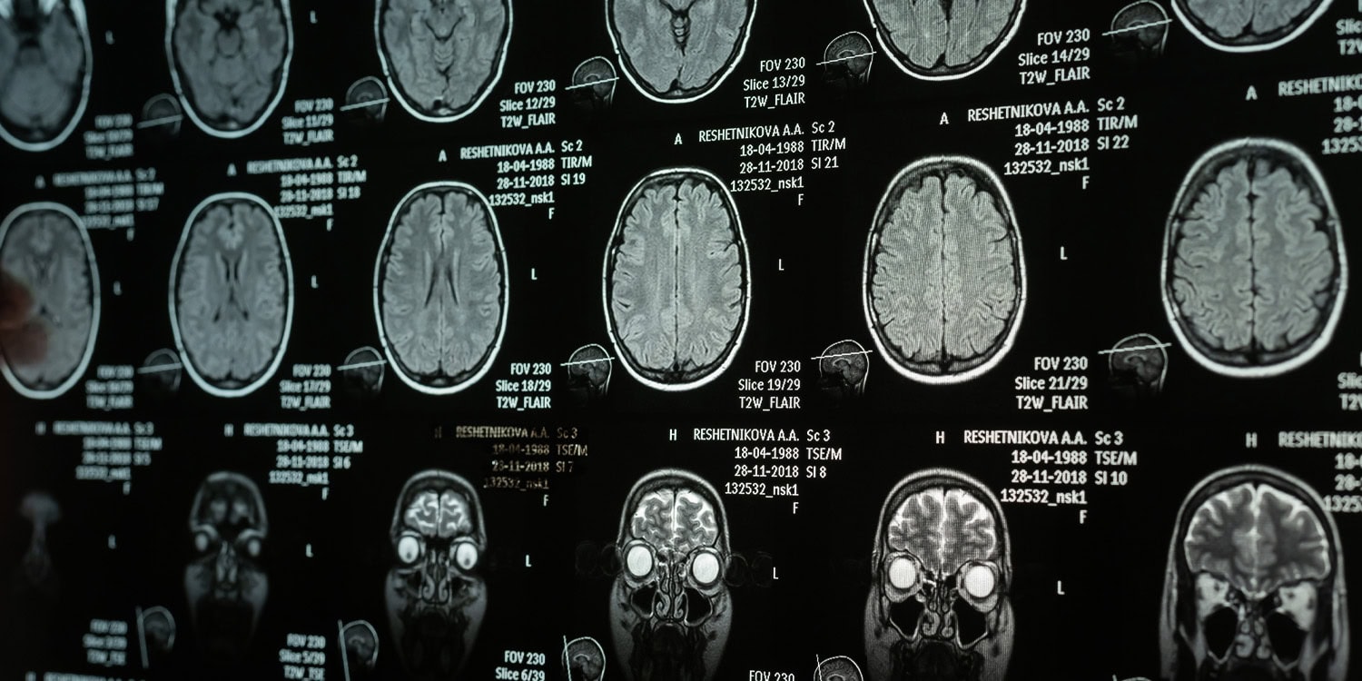 Featured image for Early Detection and Prevention of Alzheimer’s Through New Biomarkers and Protein Targets