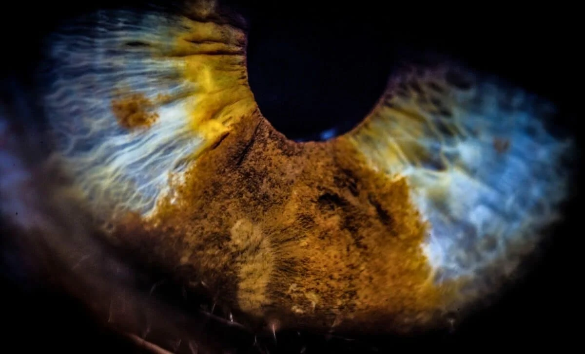 Retinal Chlamydia pneumoniae Tied to Faster Alzheimer’s Progression