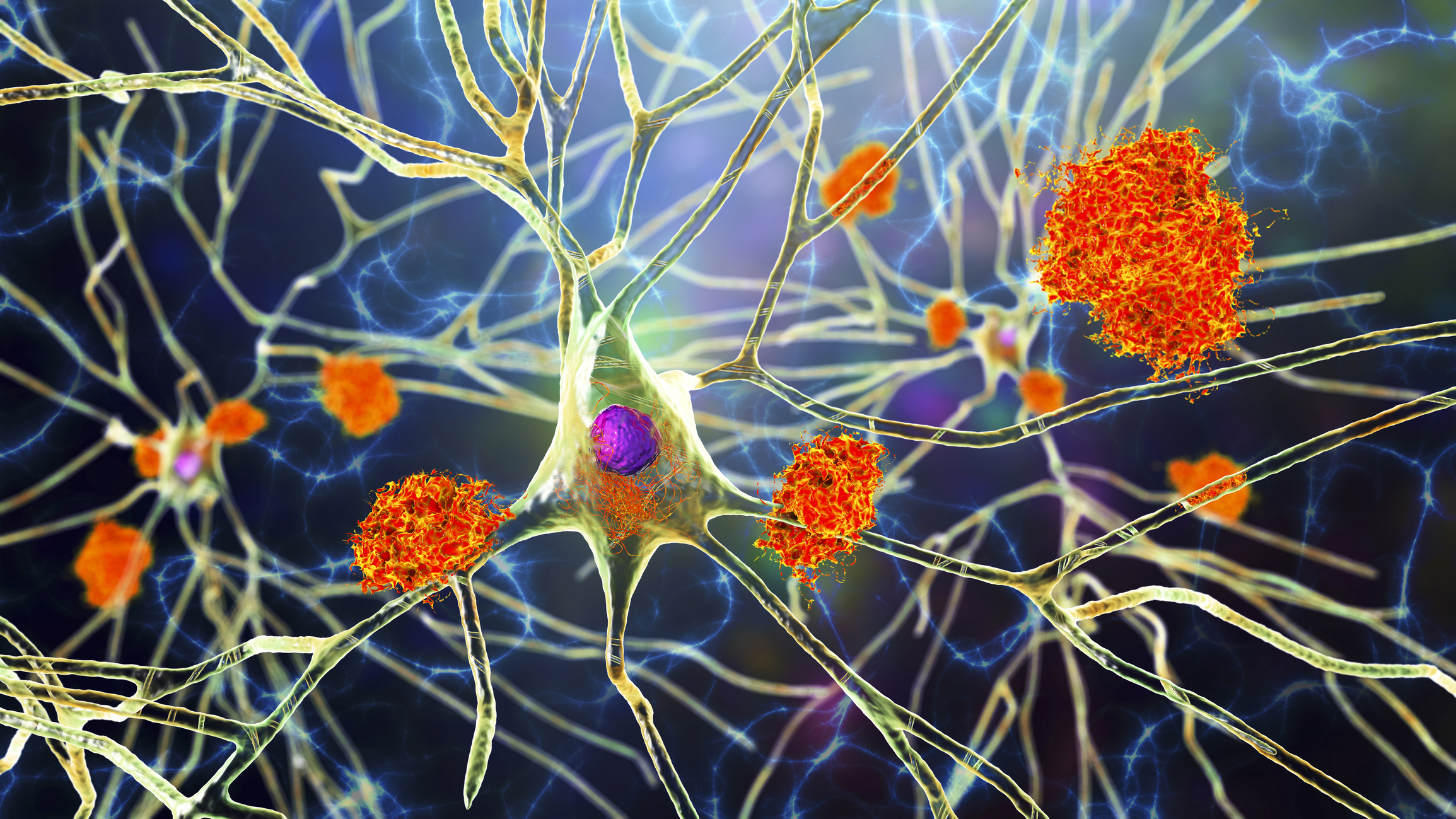 "New Alzheimer's Treatment Targets Plexin-B1 to Halt Disease Progression"