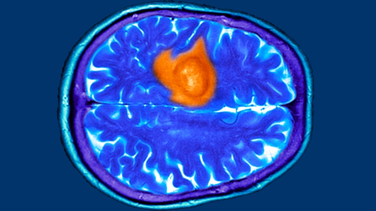 Featured image for 7 Hidden Signs of Brain Tumors That Require Early Detection
