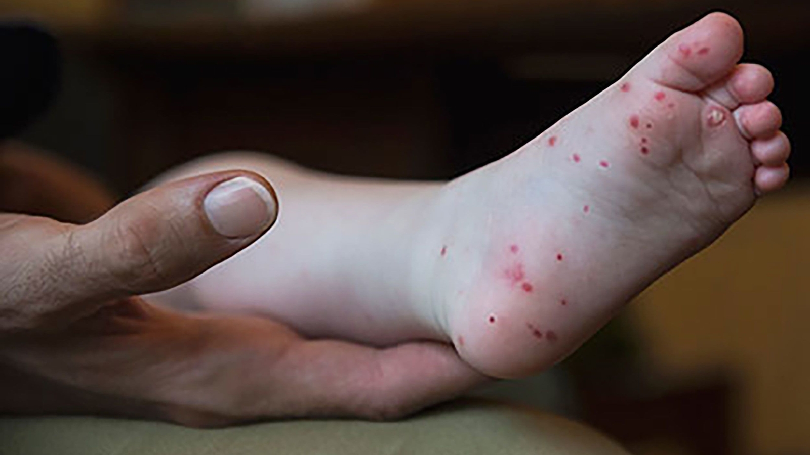 Featured image for Rising Hand, Foot, and Mouth Disease Cases Prompt Caution in Maryland Schools