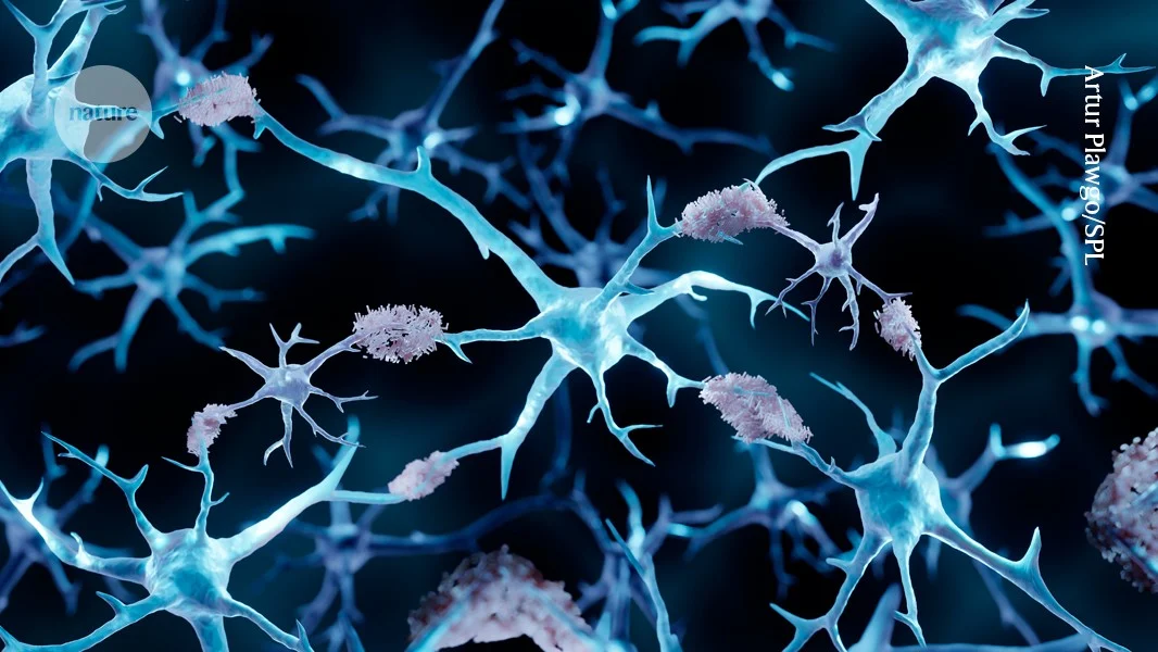 Cancer-produced protein dissolves Alzheimer’s plaques in mice, hinting at new treatments