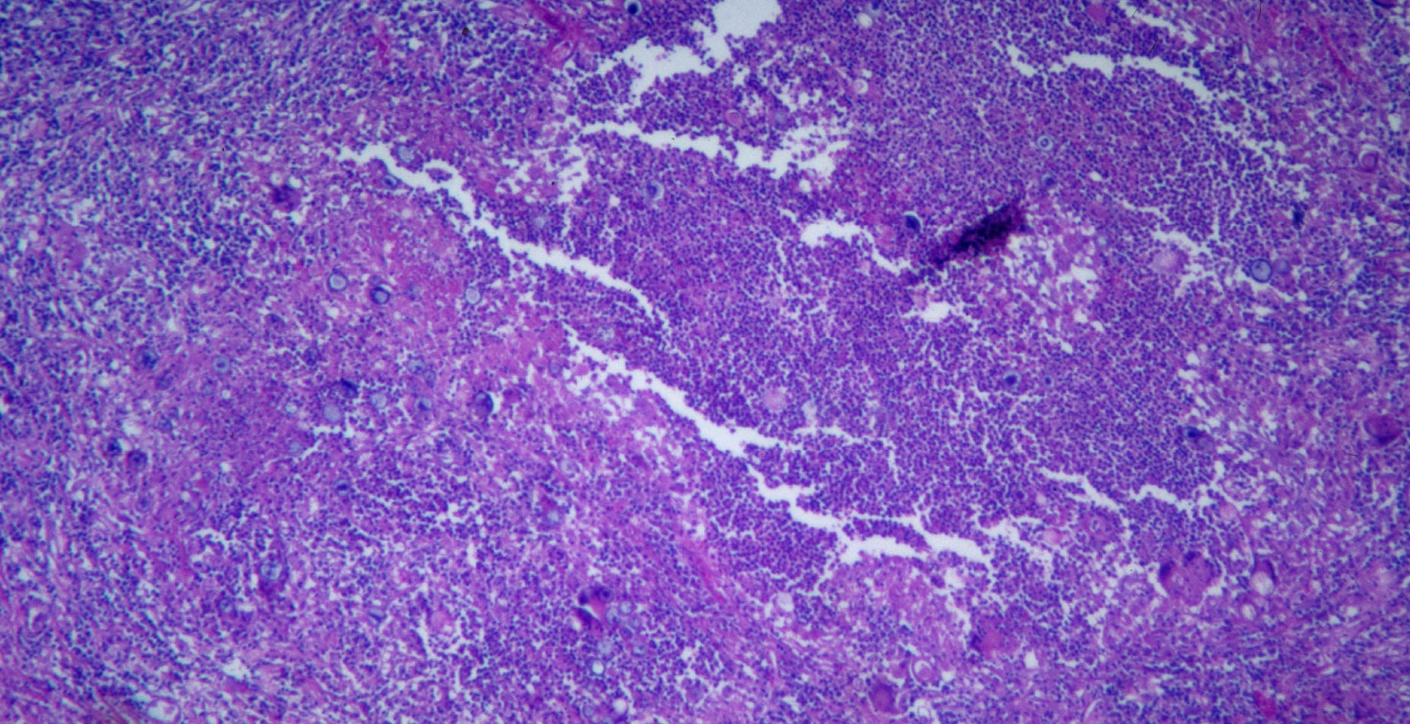 Featured image for Valley Fever Surge: A Growing Health Crisis on the West Coast