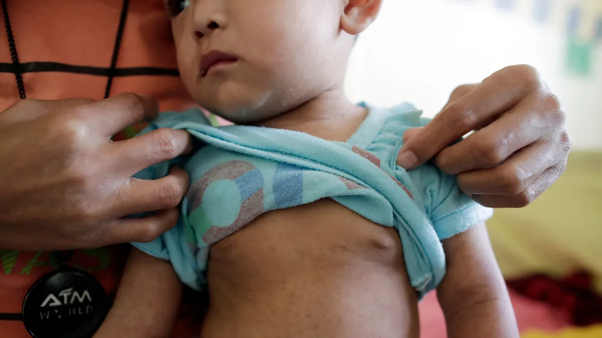 Featured image for Measles Outbreak Threatens Michigan as Vaccination Rates Decline