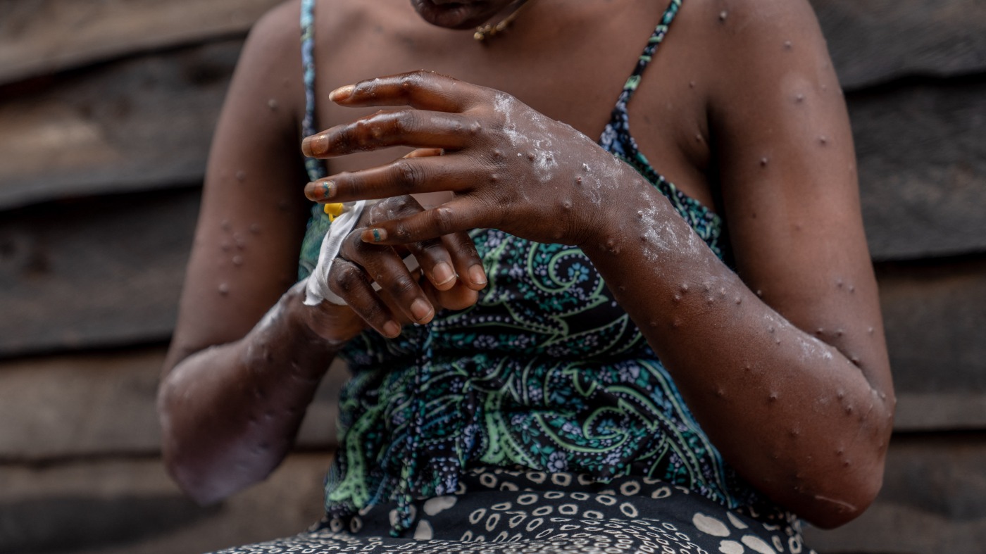 Featured image for Global and Zimbabwean Efforts Continue Amid Ongoing Mpox Threats