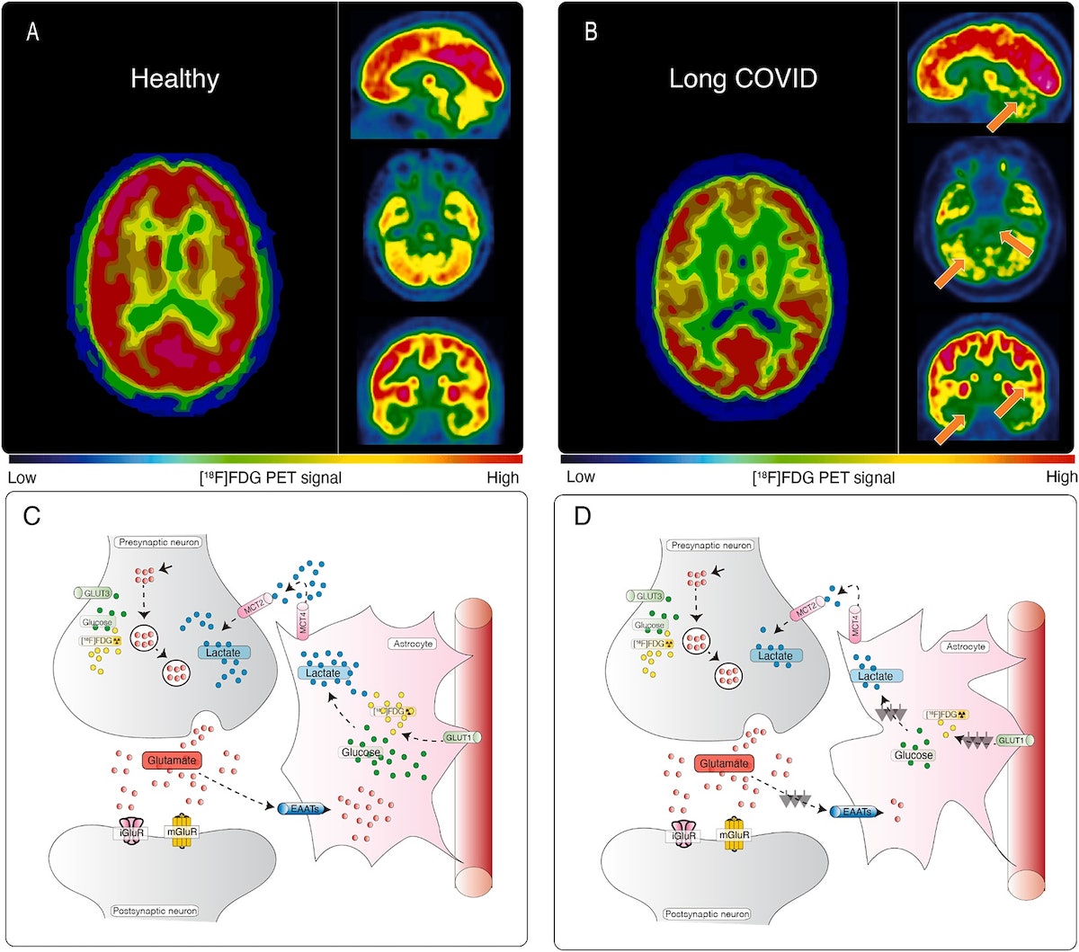 Featured image for Unraveling the Links: Long COVID, Brain Fog, Menopause, Gut Infection, and Low Hormone Levels