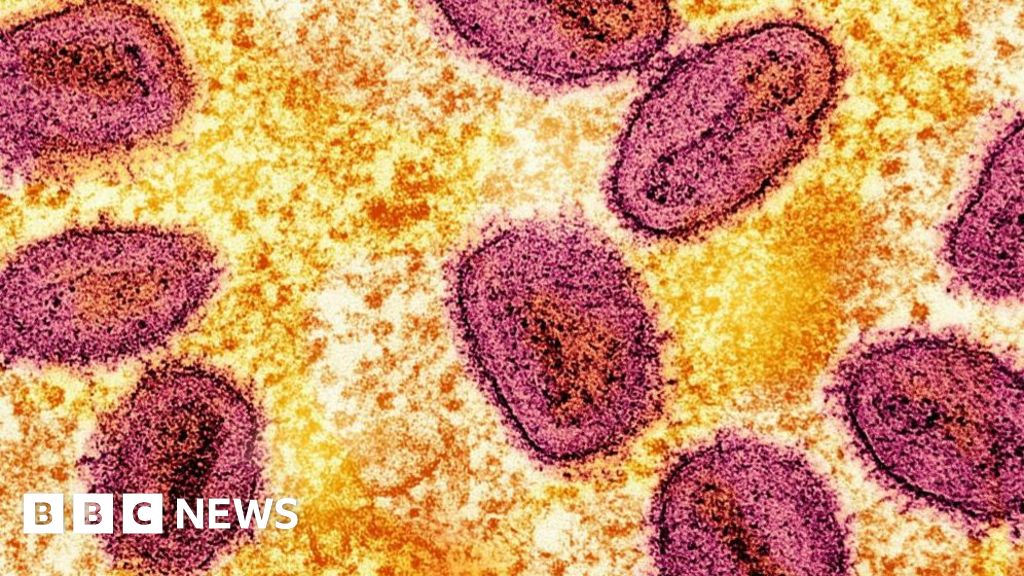 Featured image for UK Faces Rising Cases of New Mpox Strain