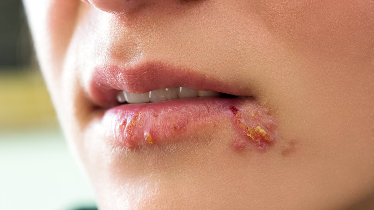 Featured image for "Link Between Cold Sores and Dementia Risk Confirmed in New Study"