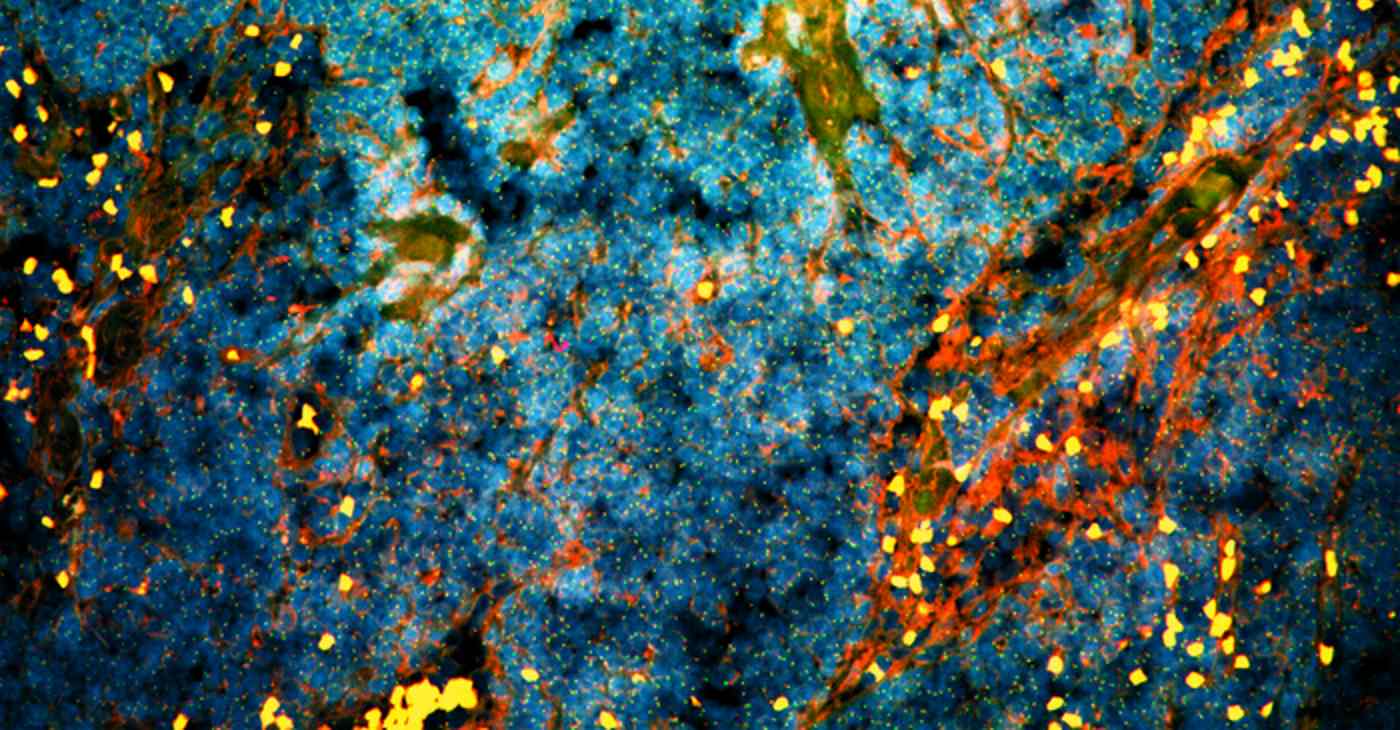 Featured image for Breakthrough Supplement Triggers Self-Destruction in Prostate Cancer Cells