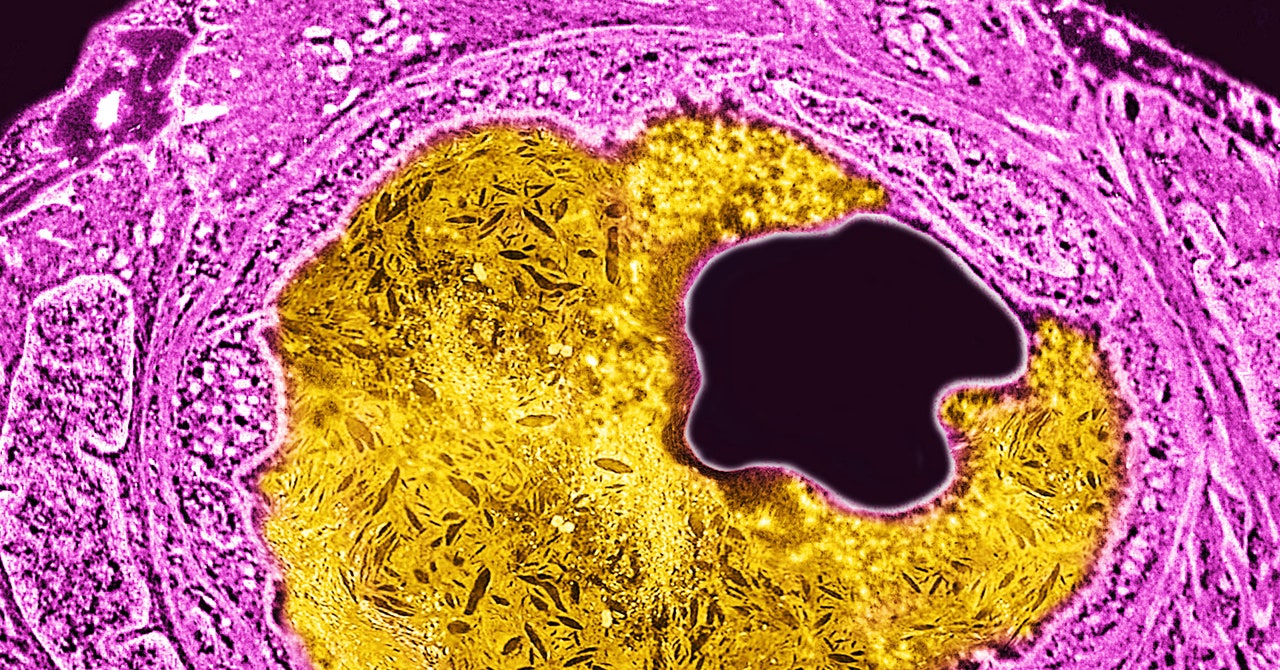 "Gene-Editing Treatment: A Promising Solution for Lowering High Cholesterol"