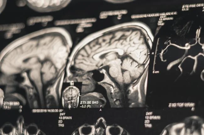 Severe CTE Linked to Dementia Risk, NIH Study Finds