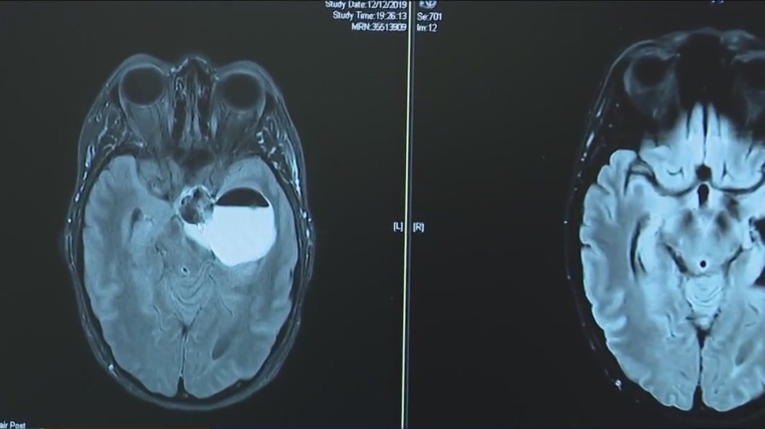Featured image for Unexpected Brain Tumor Diagnosis: Woman's Journey from Ear Infection to Surgery