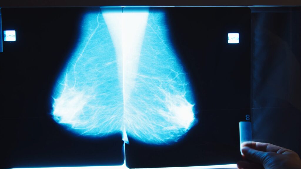 Featured image for AI Mammography Debuts Amid Trust Concerns
