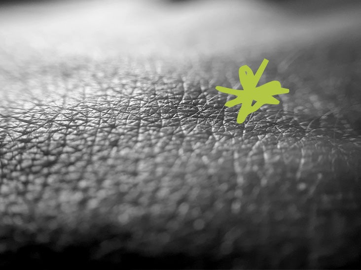 The Role of Bacteria in Eczema Development