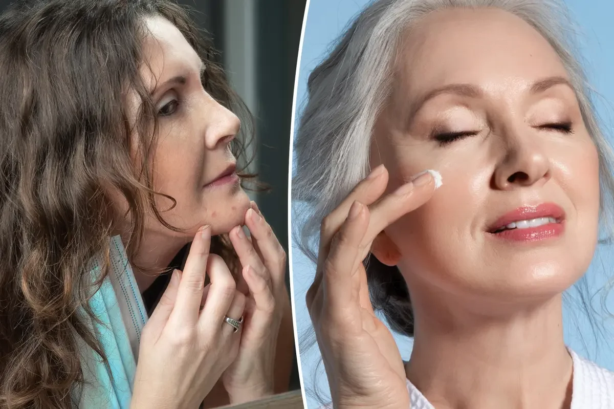 Midlife Hormonal Acne: Menopause Reopens the Skin Battle