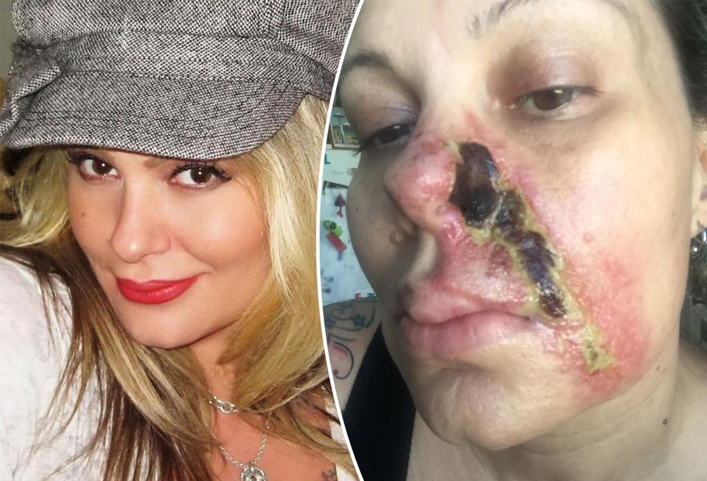 Featured image for The Dangers of Face Fillers: A Cautionary Tale