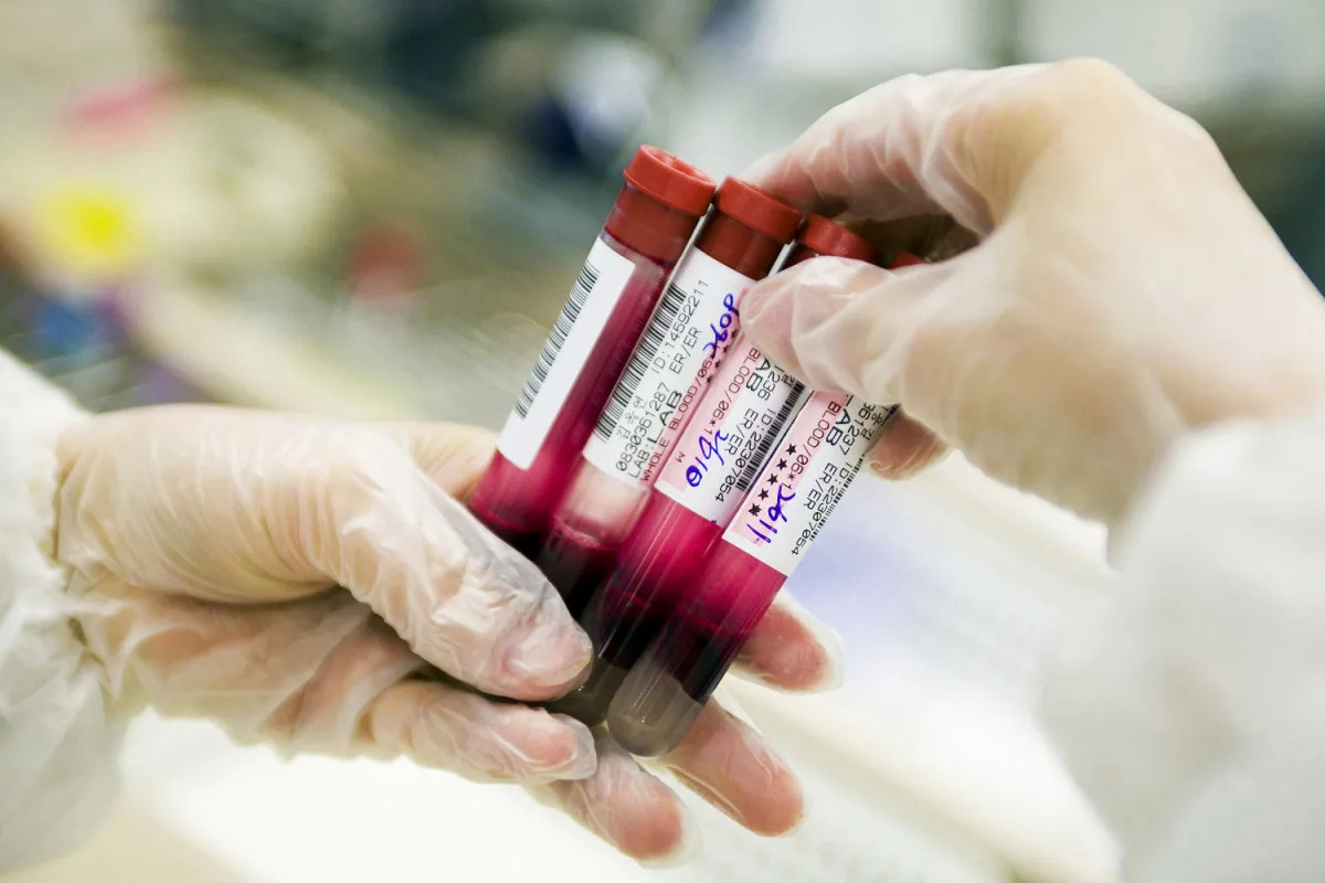 Featured image for The Surprising Link Between 'Good' Cholesterol and Dementia